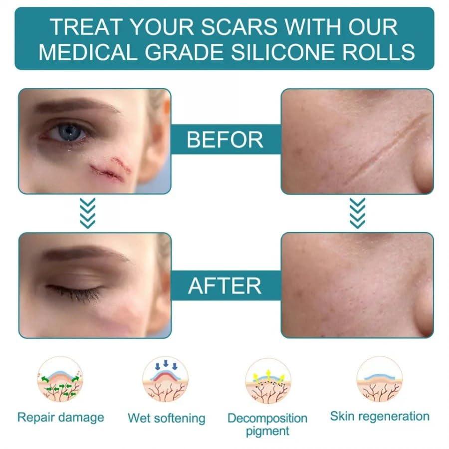 Scar Removal Tape Scar Removal Sheet Strips for C-Section, Acne Scars, Tummy Tuck, Keloid and Surgical Scars, Reusable Medical Grade Silicone Scar Tape, Get Scars Away Painless
