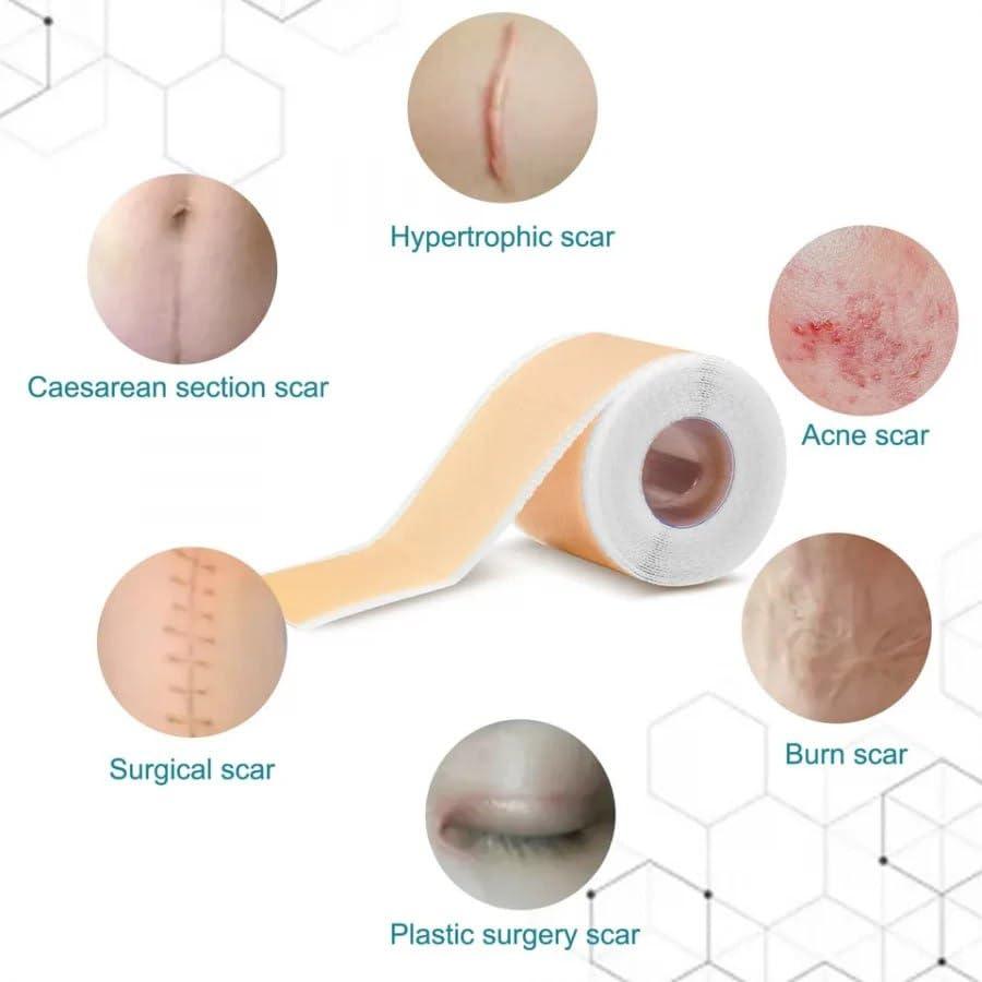 Scar Removal Tape Scar Removal Sheet Strips for C-Section, Acne Scars, Tummy Tuck, Keloid and Surgical Scars, Reusable Medical Grade Silicone Scar Tape, Get Scars Away Painless